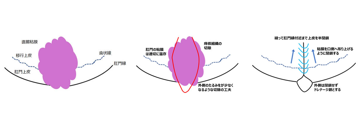 LEEPL法