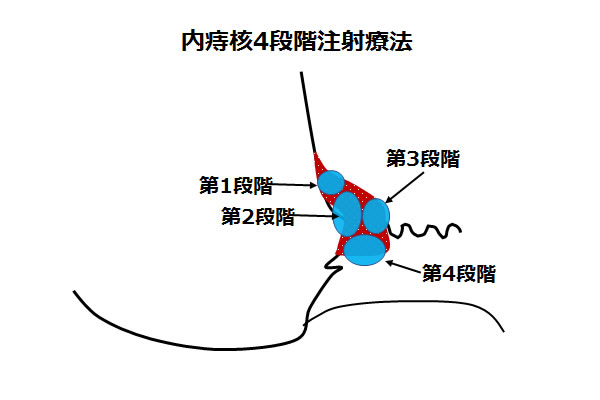 内痔核 ジオン注